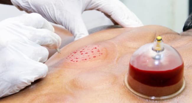 پاورپوینت حجامت