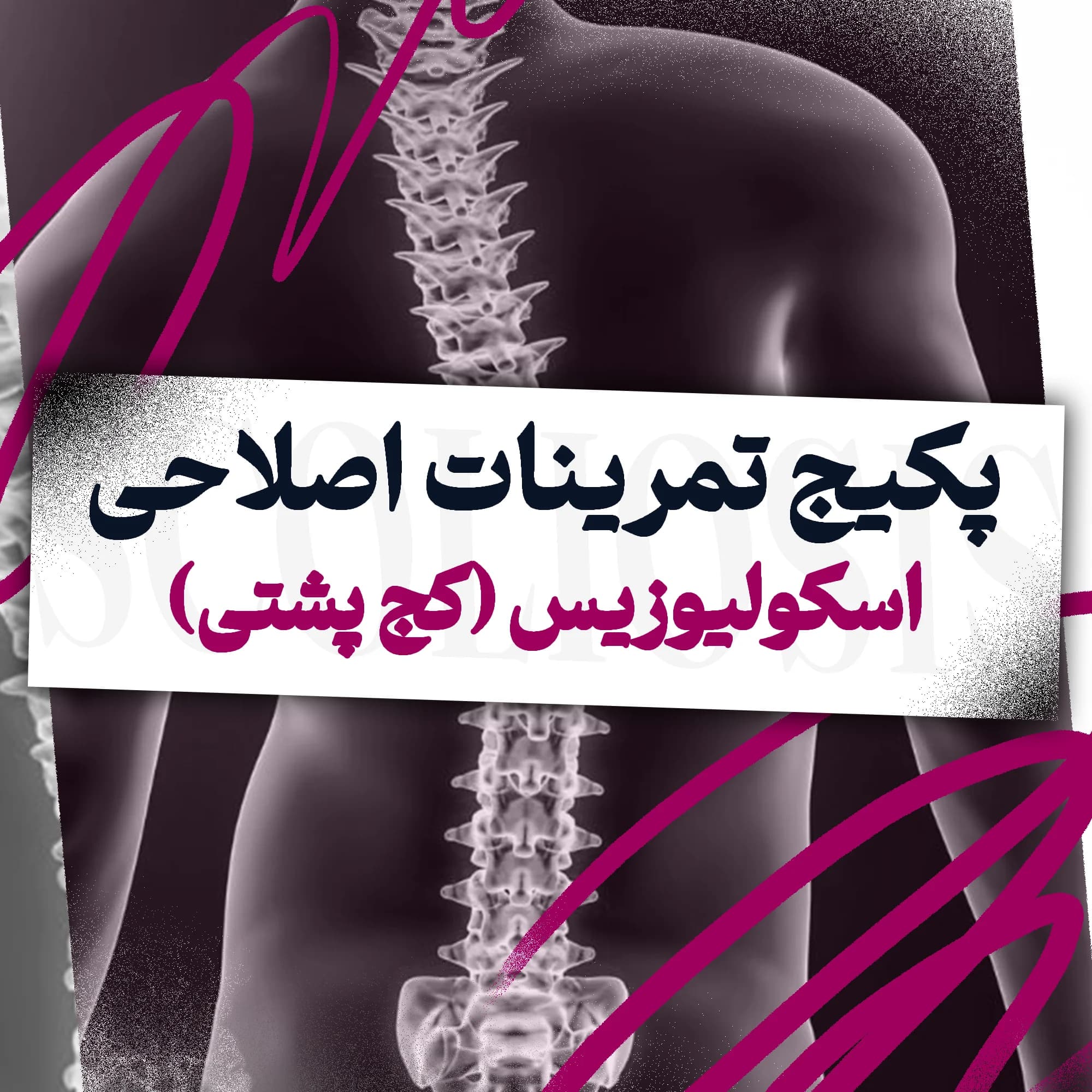 تمرینات اصلاحی اسکولیوزیس (کج پشتی)
