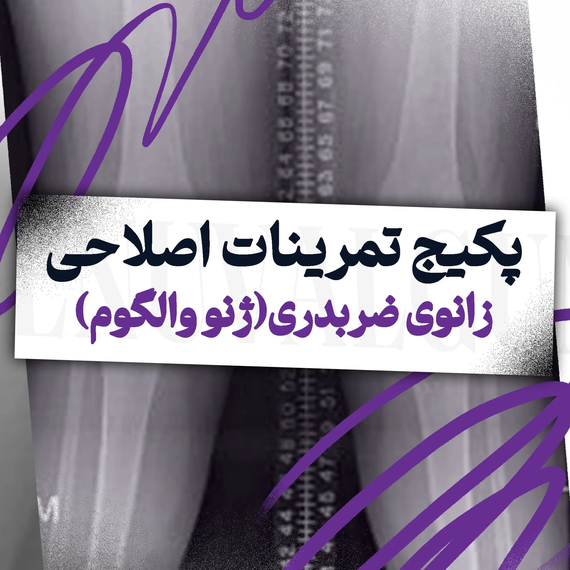 تمرینات اصلاحی زانوی ضربدری(ژنو والگوم)