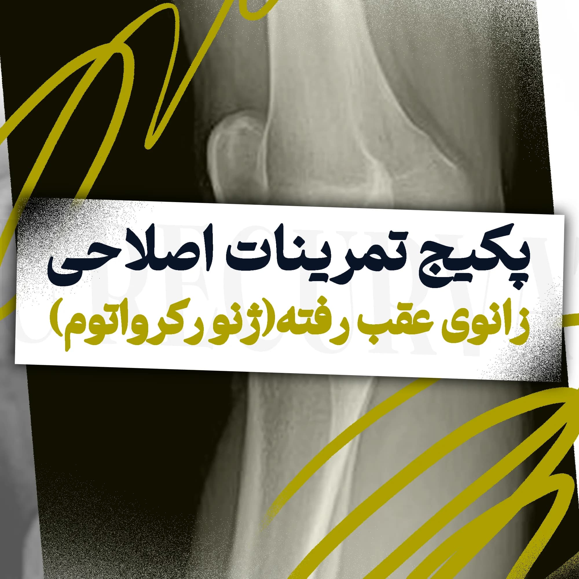 تمرینات اصلاحی زانوی عقب رفته(ژنو رکرواتوم)
