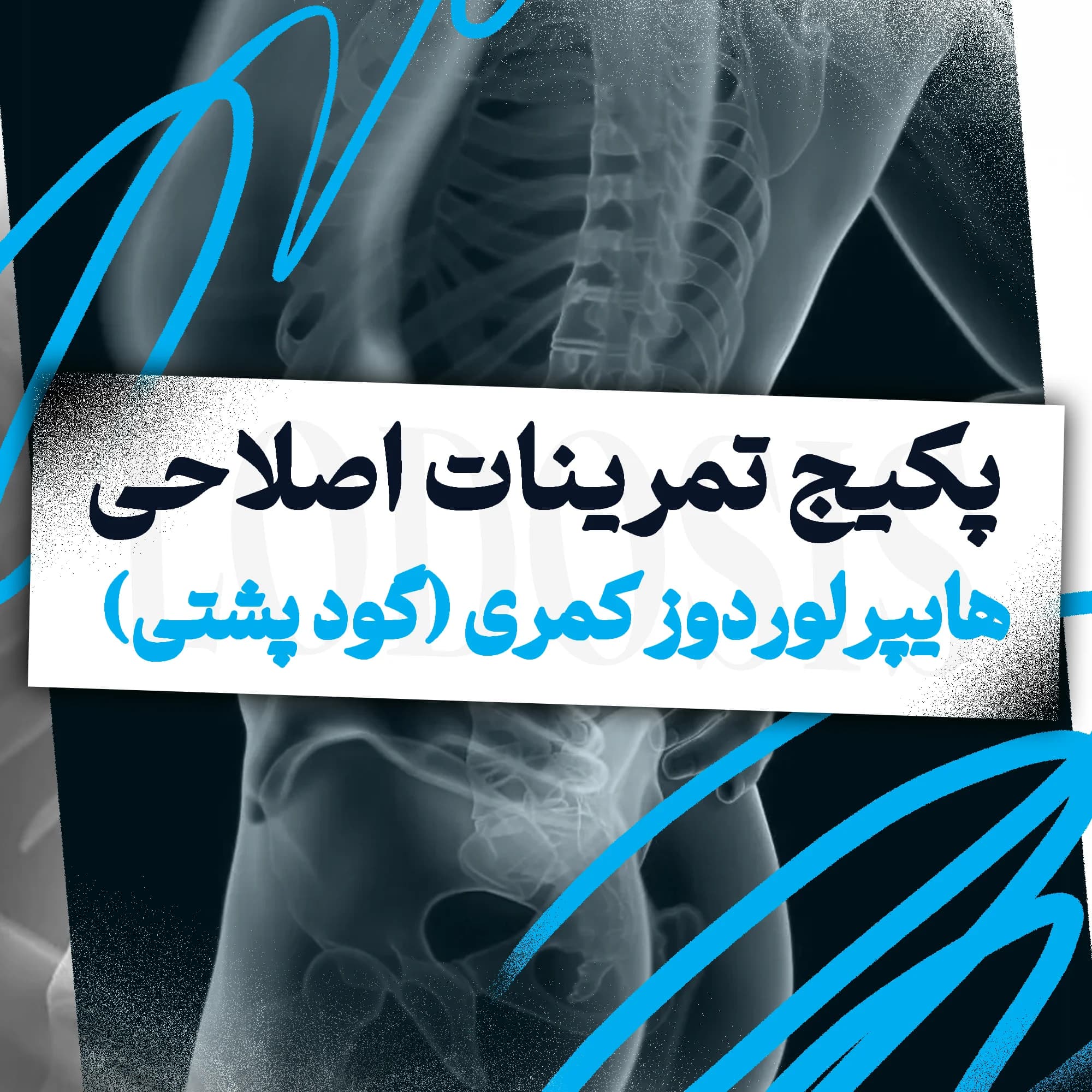 تمرینات اصلاحی هایپرلوردوز کمری (گود پشتی)
