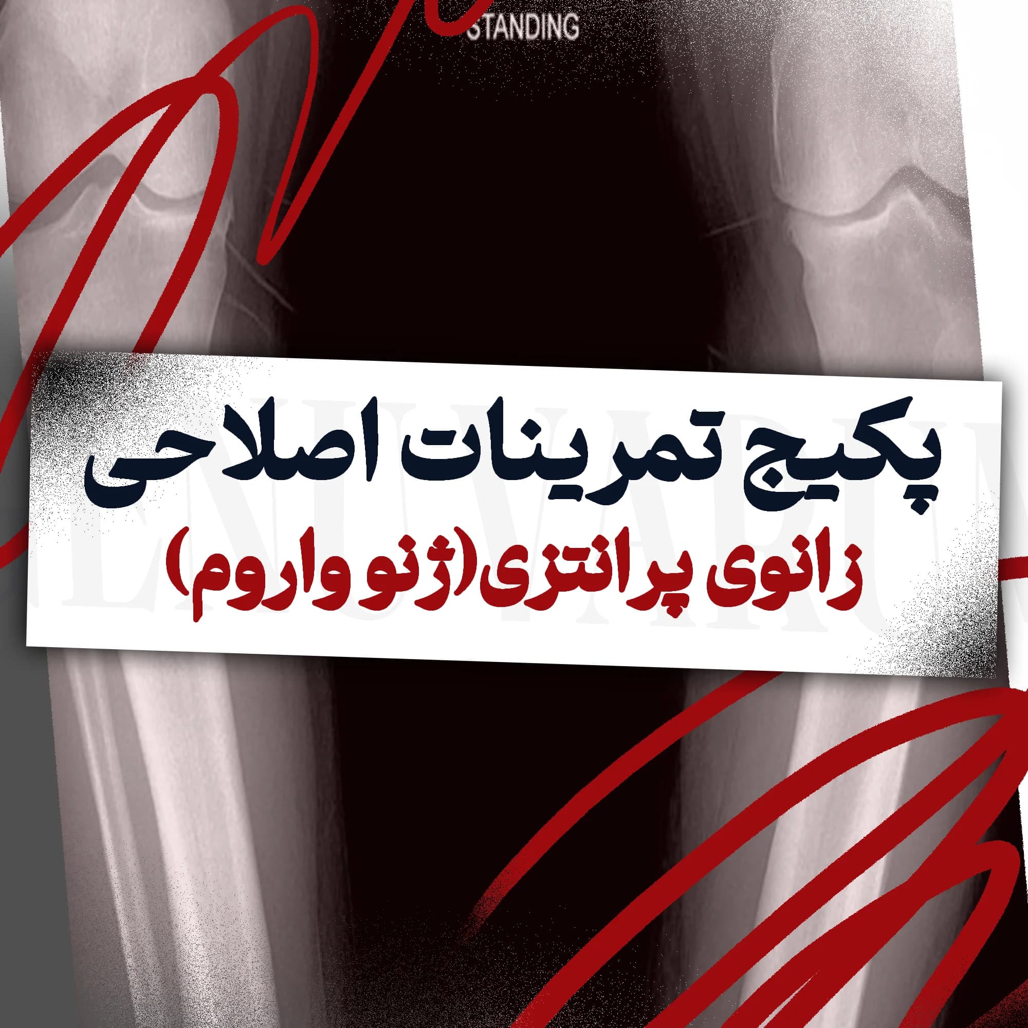 تمرینات اصلاحی زانوی پرانتزی(ژنو واروم)