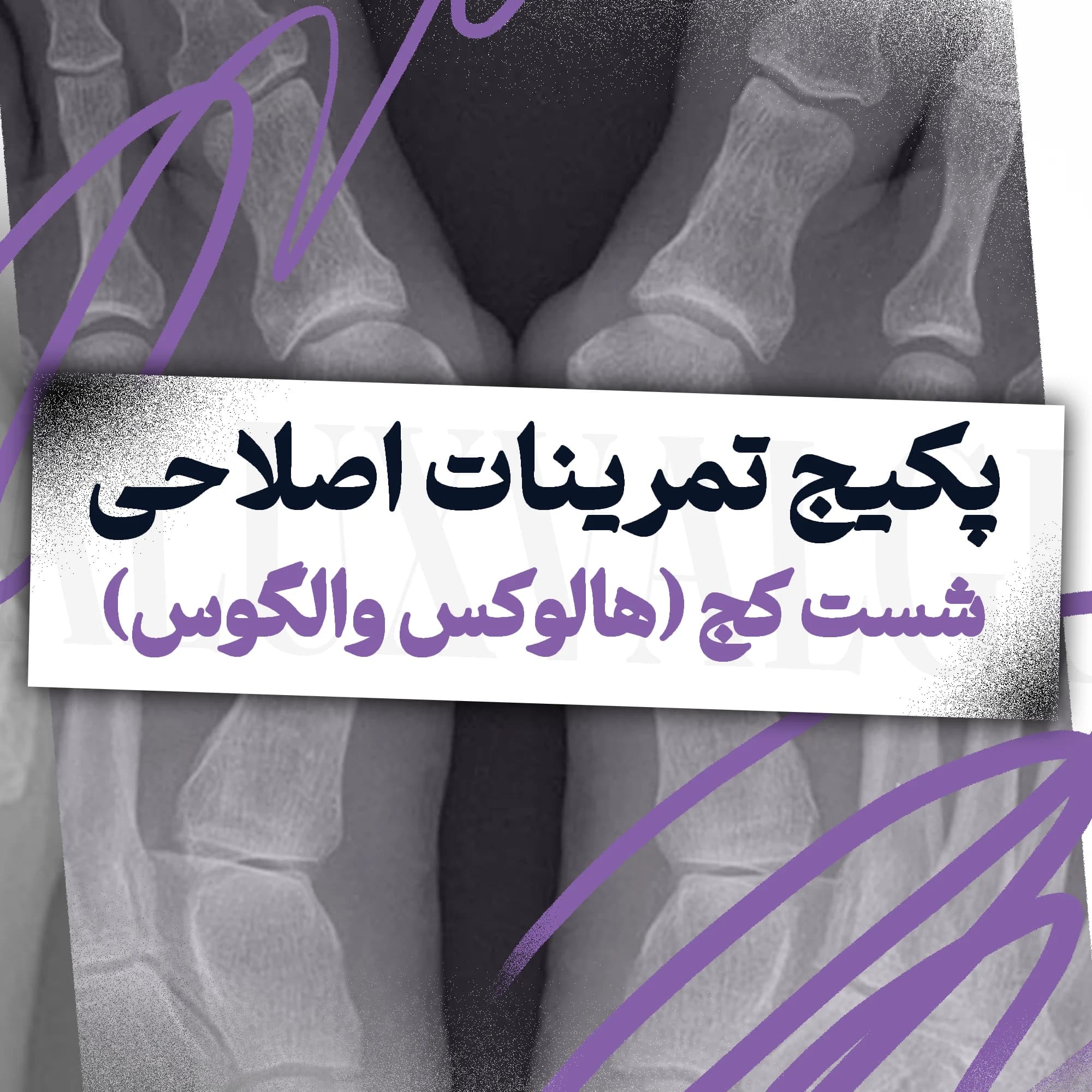 تمرینات اصلاحی شست کج (هالوکس والگوس)
