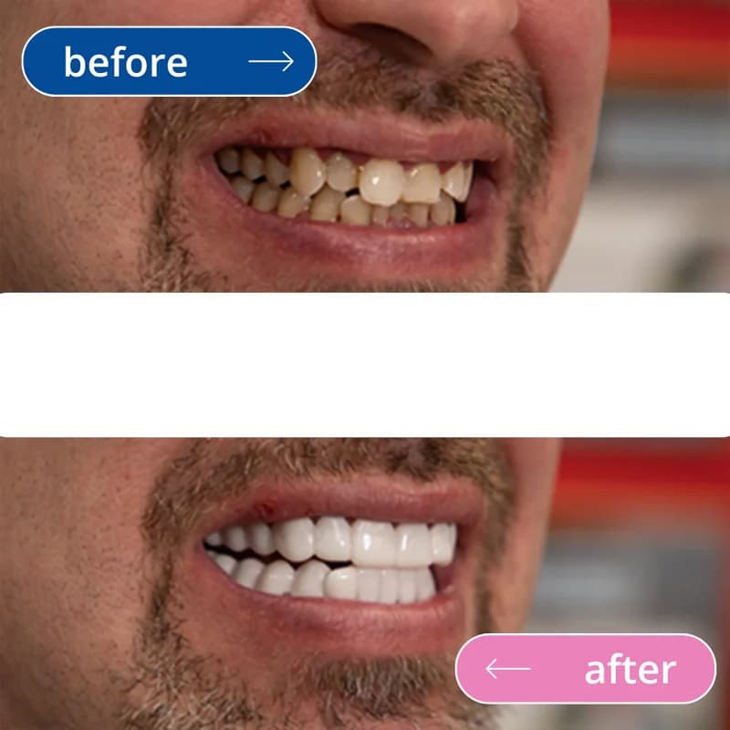 لمینت دندان دو فک مدل TruSmile (اورجینال) کدN960 — تصویر ۲