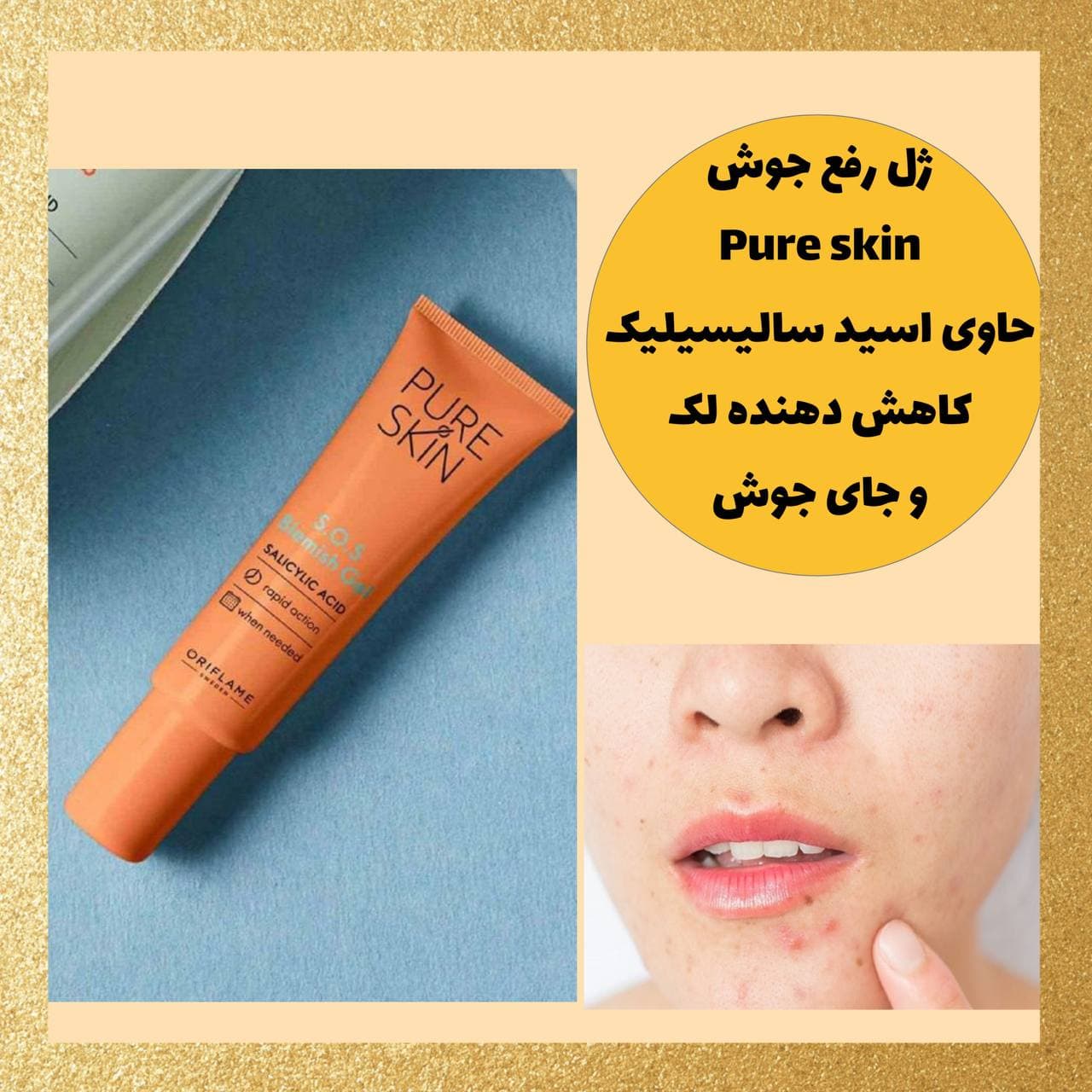 ژل ضد جوش SOS اوریفلیم مدل Pure Skin با اسید سالیسیلیک