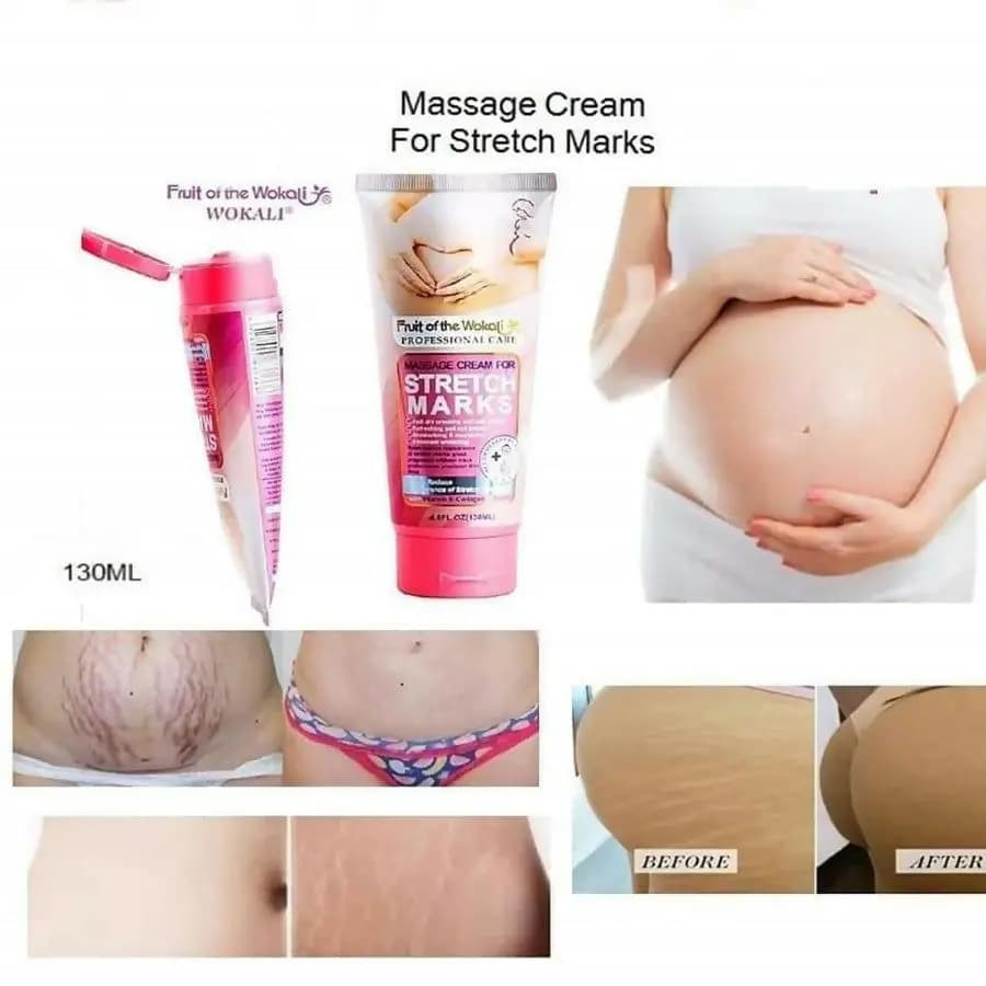 کرم درمان ترک پوستی ووکالی Stretch Marks حجم 130 میل — تصویر ۲