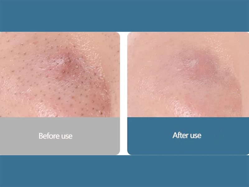 دستگاه پاک کننده صورت هوشمند شیائومی یوپین Xiaomi Youpin Wisdom Intelligent Visible Pore Cleaner — تصویر ۵
