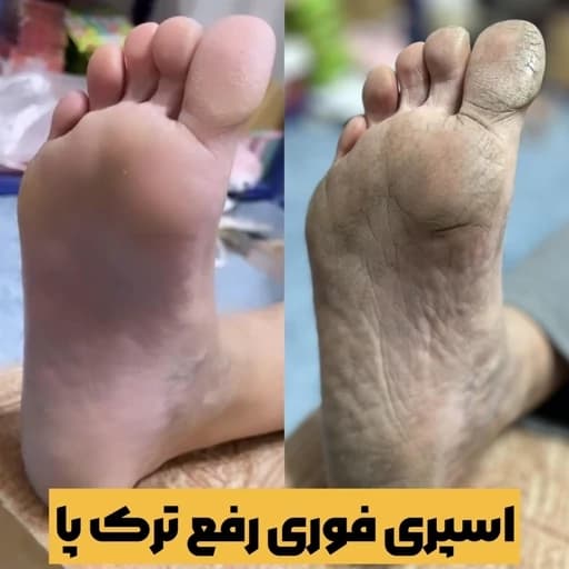 اسپری ترک پا رفع پینه پا از بین برنده ترک کف پا و قوزک پا لایه بردار روشن کننده و شفاف کننده پوست اسکراب پا ویتامین سی — تصویر ۴