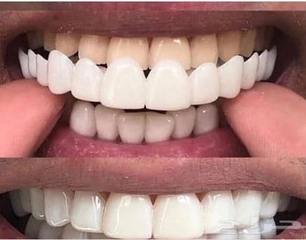 لمینت دندان پودری sowsmile دو فک — تصویر ۵