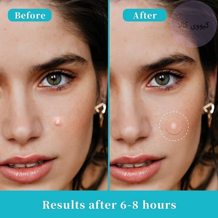 پچ ضد جوش کوزارکس Cosrx مدل پیمپل مستر پچ Pimple Master patch — تصویر ۳