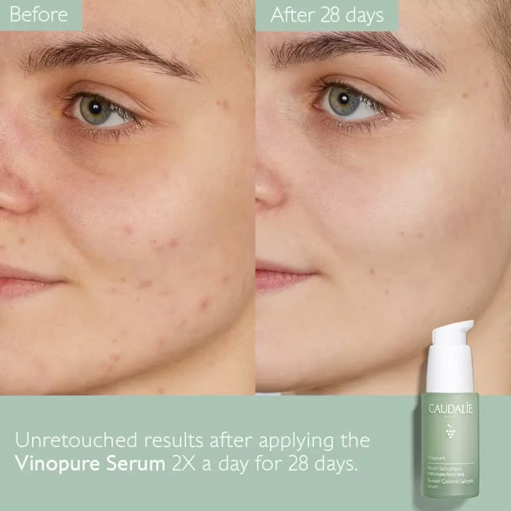 سرم ضدجوش کدلی Vinopure — تصویر ۳