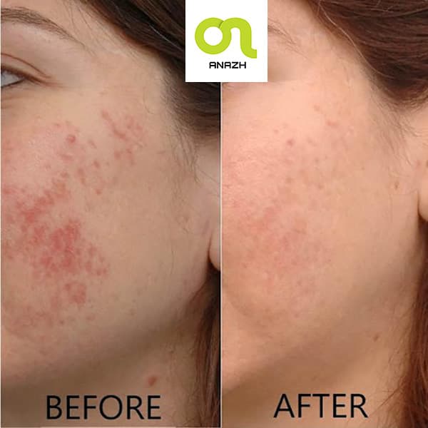 سرم ضدلک و روشن کننده آسکوربیک اسید(ویتامین C) 8% و آلفا آربوتین 2% اوردینری 30 میل-اناژ — تصویر ۴