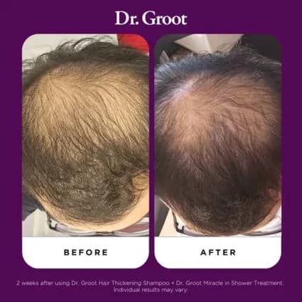 سرم ضد ریزش دکتر گروت Dr.Groot (ضخیم‌کننده قوی مو) اورجینال — تصویر ۸
