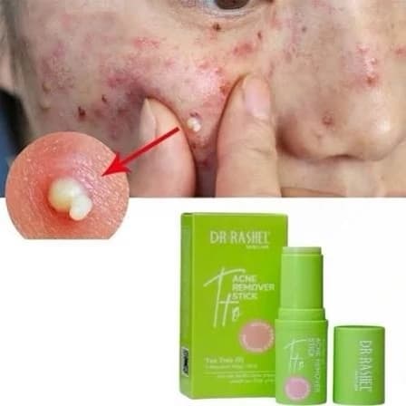 سرم استیکی ضد جوش صورت روغن درخت چای دکتر راشل (وزن 7 گرم) (Tea Tree Oil Acne Remover Stick) — تصویر ۵