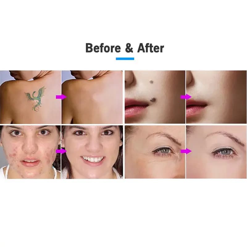 دستگاە پلاسما فیوژن نیوفیس ایکس پل X peel — تصویر ۳