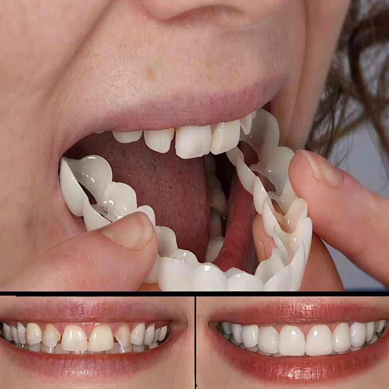 لمینت دندان دو فک مدل Snap on Smile — تصویر ۴