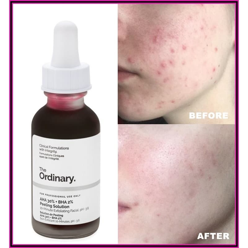 سرم ضدلک پیلینگ و لایه بردار AHA 30% + BHA 2% اوردینری حجم 30 میل — تصویر ۴