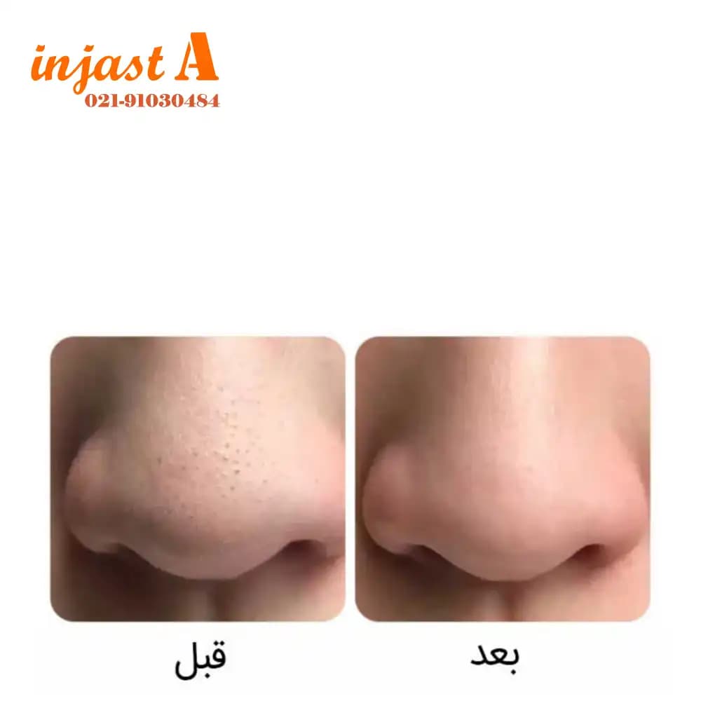 ماسک بینی سه مرحله ای ضدجوش سرسیاه بیوآکوا مدل STEP 3 — تصویر ۳