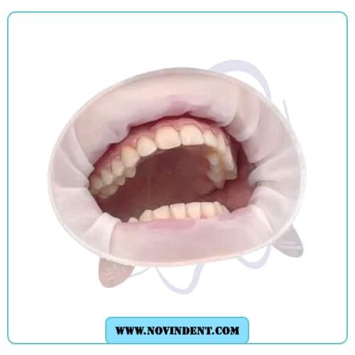 دهان باز کن اپتراگیت ایوکلار – IVOCLOR