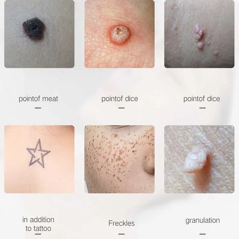 بیوتی پن 9 قدرته چراغ دار MOLE REMOVAL PEN — تصویر ۴