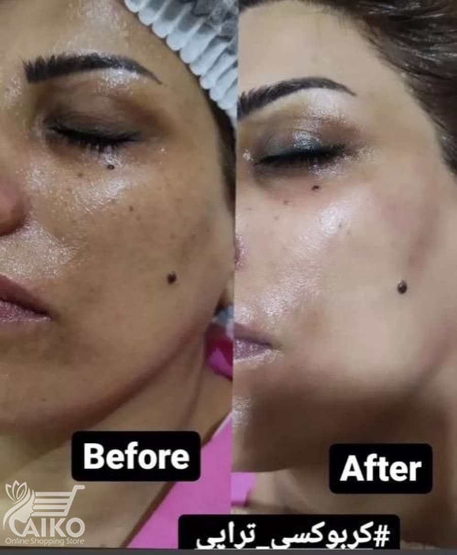 ژل کربوکسی تراپی هیالورونیک اسید دکتر درمر Dr Dermer — تصویر ۶