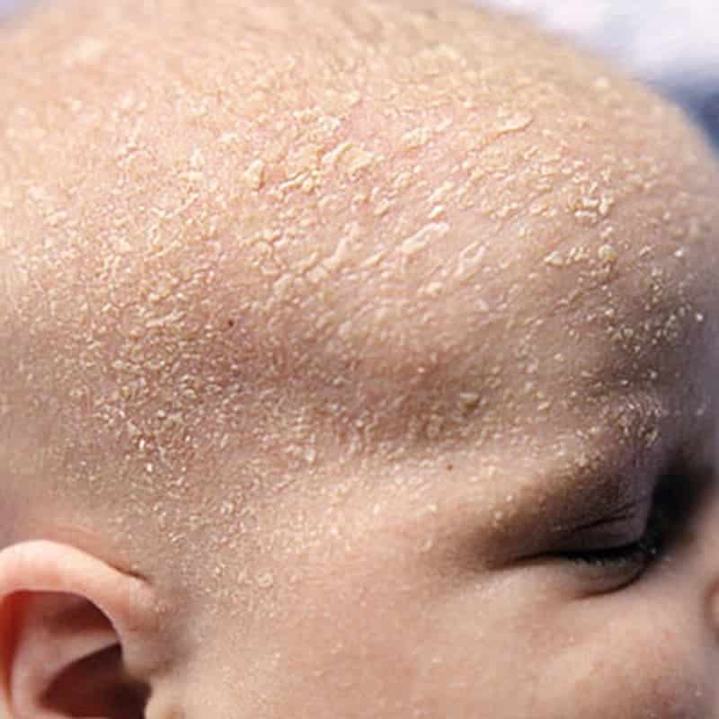 کرم برطرف کننده پوسته های چرب سر نوزاد 30میل هیدرودرم — تصویر ۵