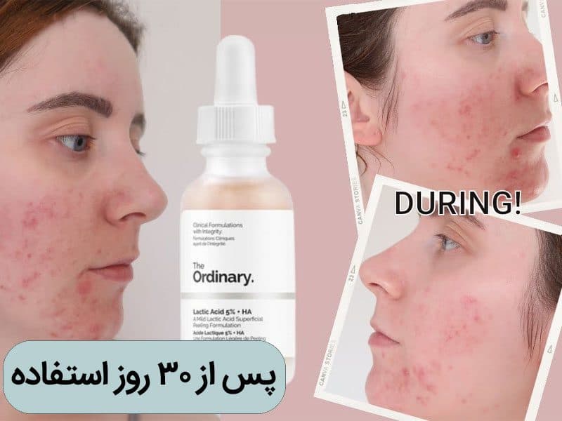 سرم لاکتیک اسید روشن کننده جوانساز و لایهبردار اسید لاکتیک 5% + HA — تصویر ۵