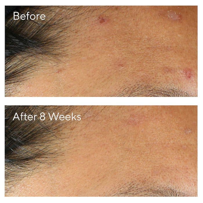 کرم ضد لک آکنه مورد 30میل Murad Invisiscar Resurfacing Treatment — تصویر ۲
