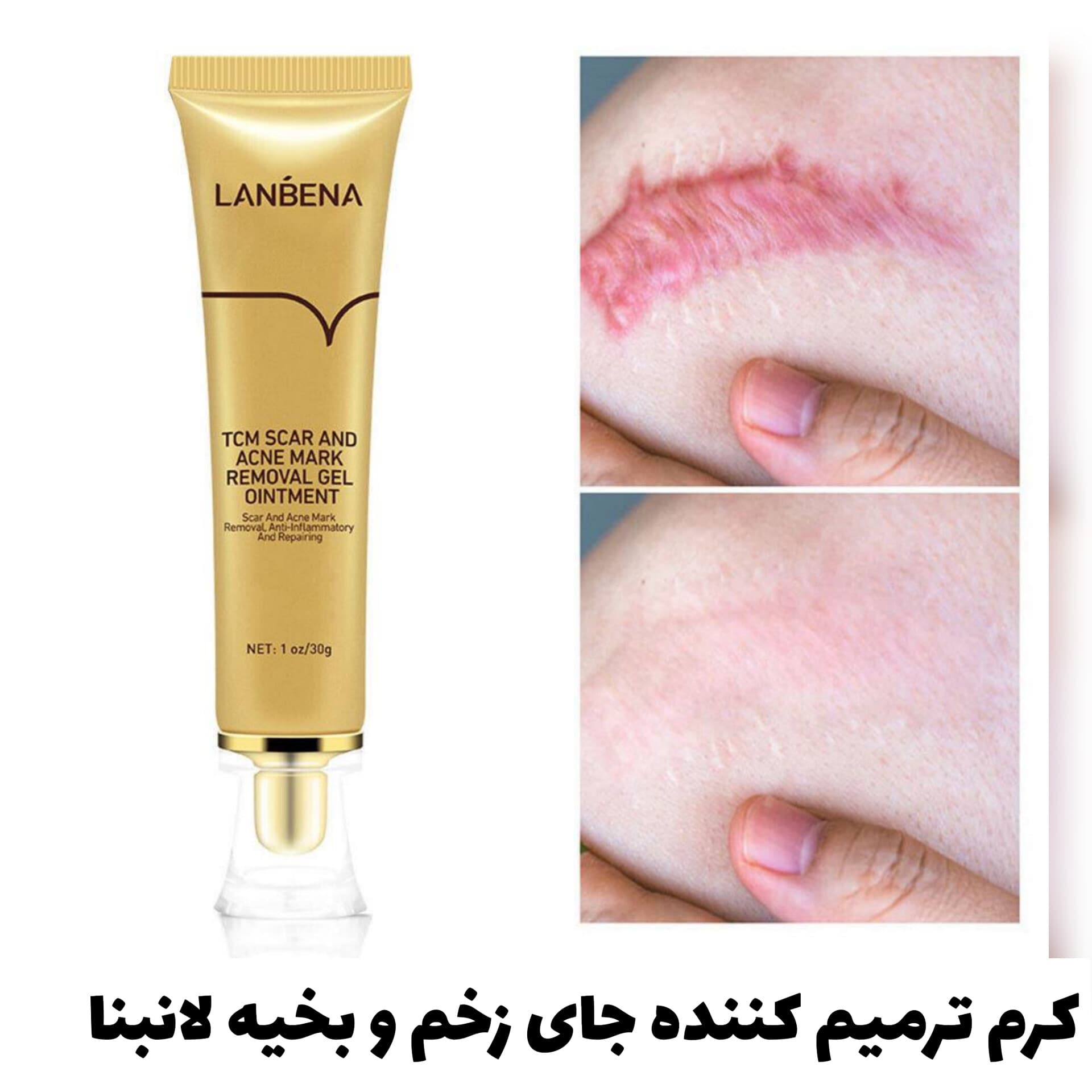 کرم ترمیم کننده جای زخم و بخیه لانبنا