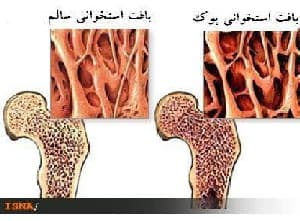 نقش ورزش در سلامت استخوان و کاهش پوکی استخوان