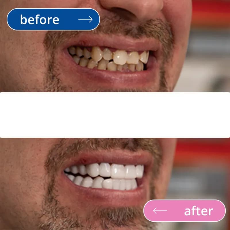 لمینت دندان دو فک مدل TruSmile به همراه نوار چسب سفیدکننده دندان کد533 — تصویر ۴