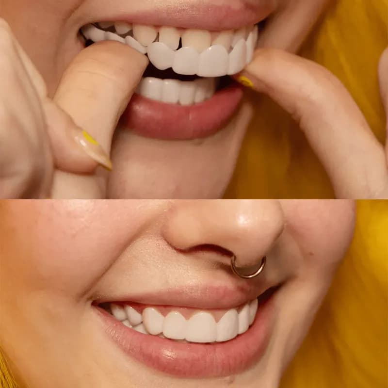 لمینت دندان دو فک مدل TruSmile به همراه نوار چسب سفیدکننده دندان کد533 — تصویر ۳