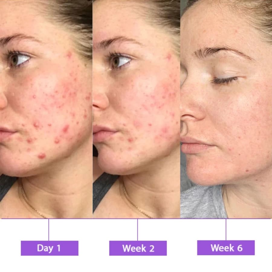 سرم آزلائیک اسید 10% و هیالورون آنوا تسکین دهنده و آبرسان | Anua Azelaic Acid 10 Hyaluron Redness Soothing Serum — تصویر ۳