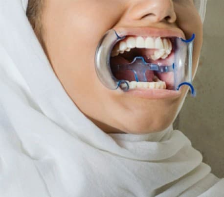 دهان بازکن و زبانگیر (رترکتور) قابل اتوکلاو SAM