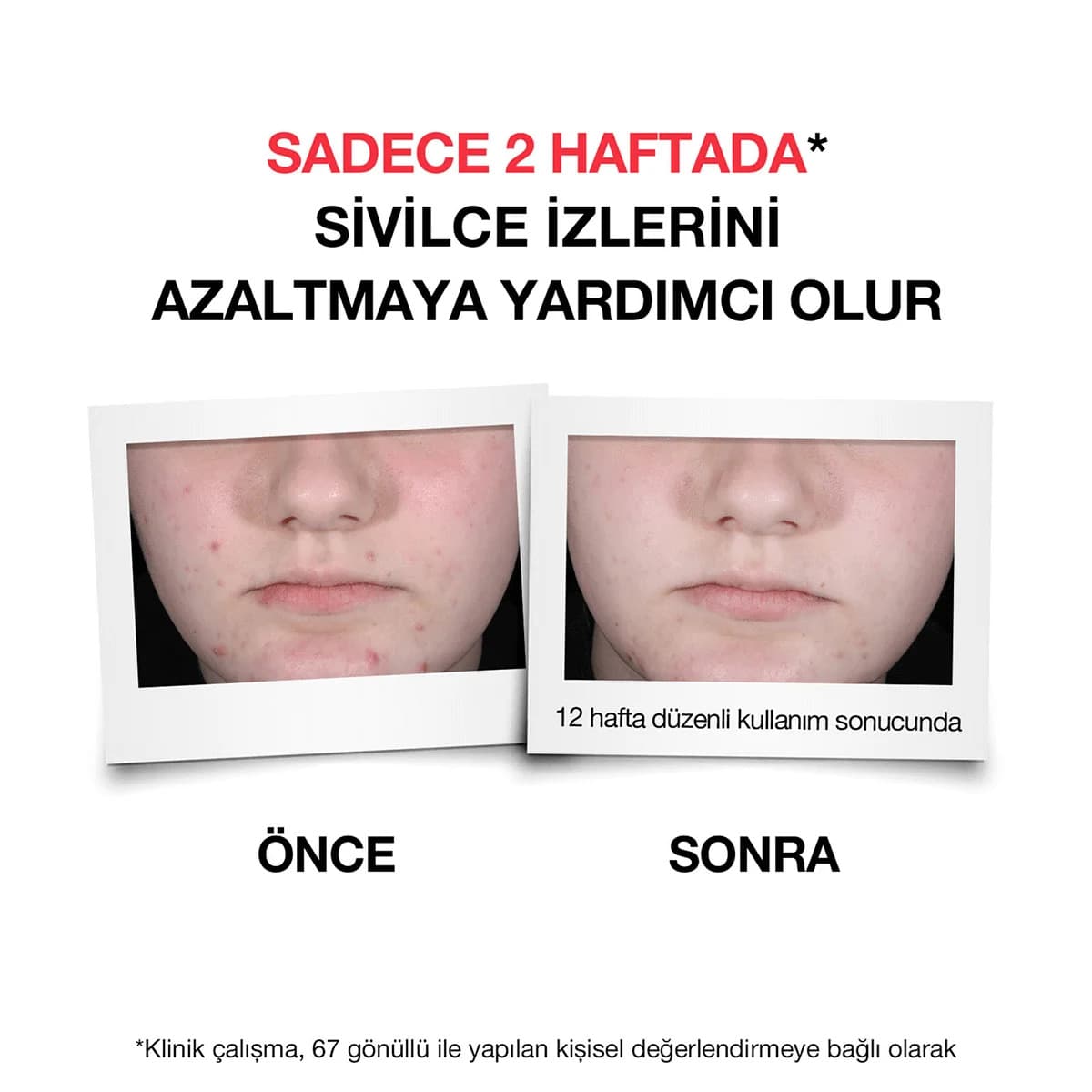 سرم ضد جوش و لک نوتروژینا مدل Spot Controlling+ Daily Serum حجم 30 میل — تصویر ۲