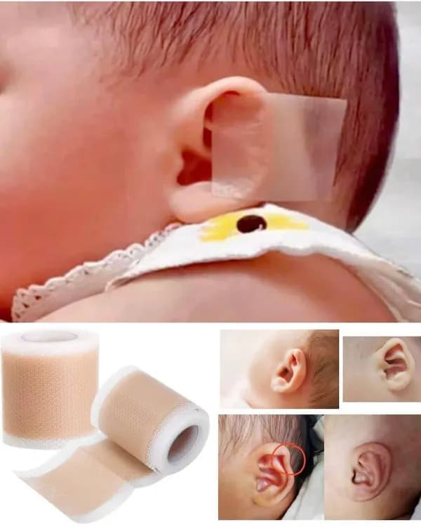 چسب اصلاح فرم گوش نوزاد 1.5 متری parhdoas — تصویر ۲