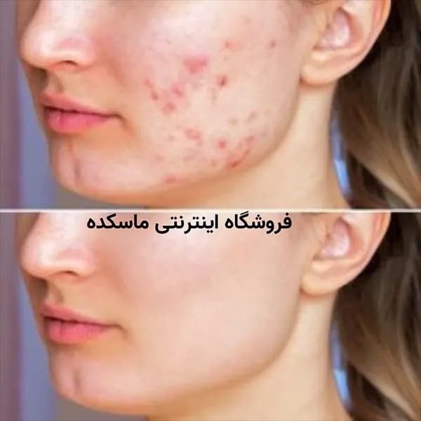 سرم ضد جوش و بستن منافذ سالیسیلیک اسید بیواکوا حجم۳۵ میل SALICYLIC ACID ACNE REMOVAL ESSENCE BIOAQUA — تصویر ۶