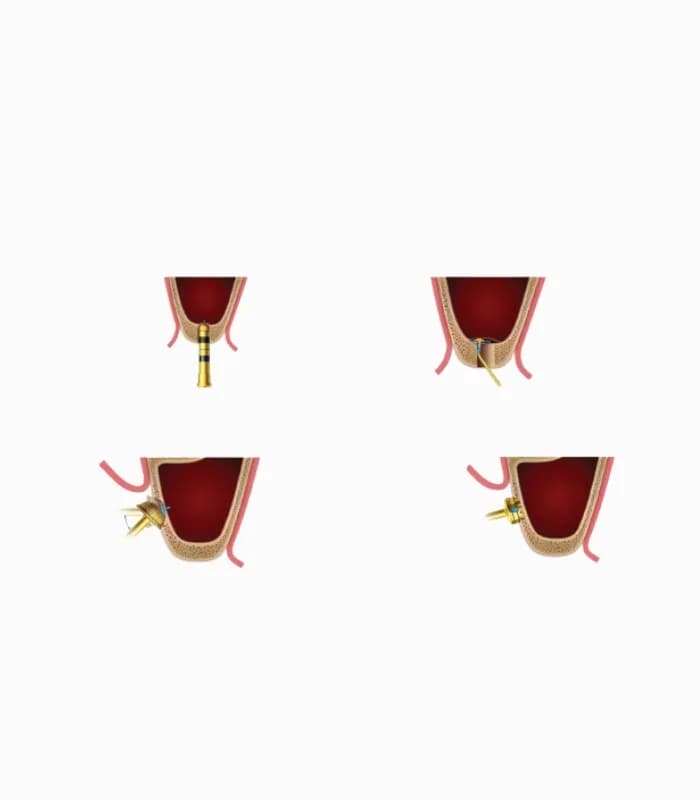 کیت پیشرفته سینوس لیفت اوپن و کلوز کاریزما – 15 عددی – Open Close Sinus Lift — تصویر ۴