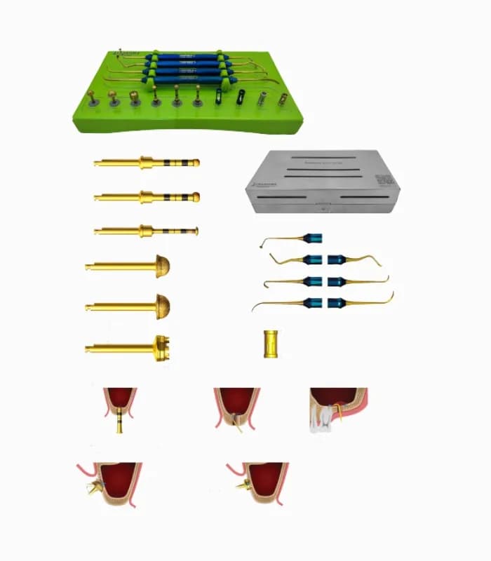 کیت پیشرفته سینوس لیفت اوپن و کلوز کاریزما – 15 عددی – Open Close Sinus Lift