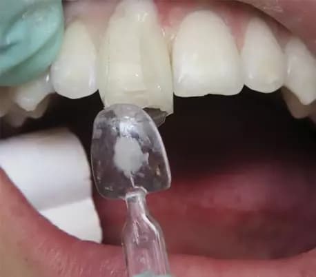 قالب پیش ساخته کامپوزیت بزرگ U Veneer Extra برند Ultradent — تصویر ۸