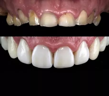 قالب پیش ساخته کامپوزیت بزرگ U Veneer Extra برند Ultradent — تصویر ۶