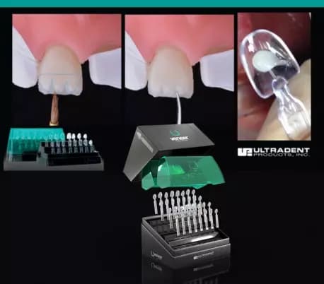 قالب پیش ساخته کامپوزیت UVeneer برند Ultradent — تصویر ۶