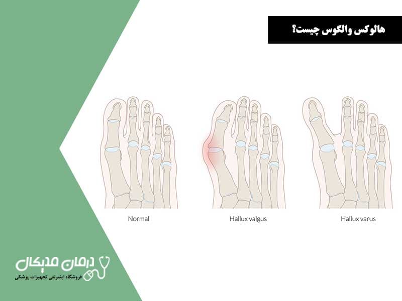 اسپیلنت هالوکس والگوس مدل Anatomic کد K16887 — تصویر ۷