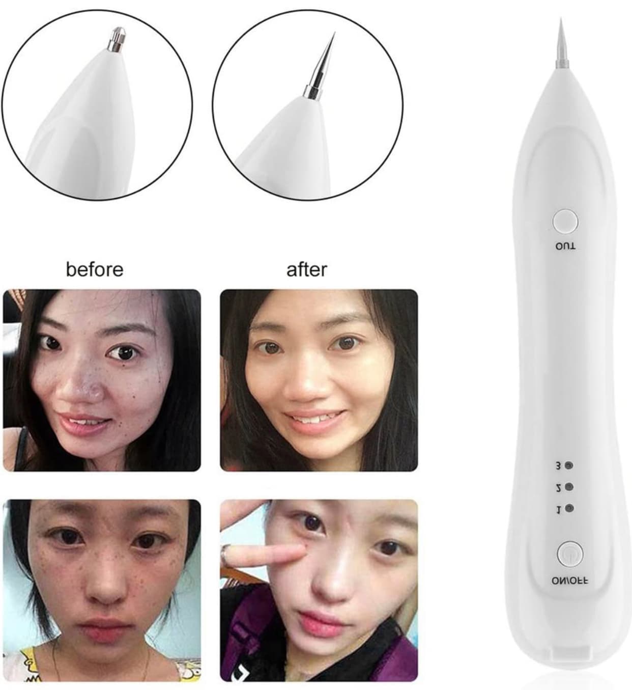 قلم پاکسازی پوست nevus — تصویر ۴