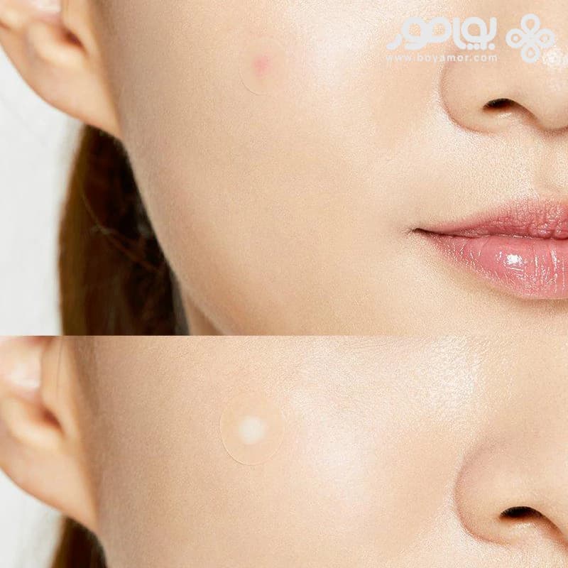 پچ ضد جوش کوزارکس مدل ACNE PIMPLE بسته 24 عددی — تصویر ۲