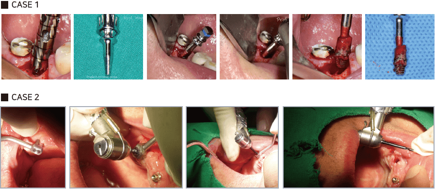 کیت ایمپلنت و اسکرو ریمور Dental studio – Implant & Screw Remover Kit — تصویر ۲