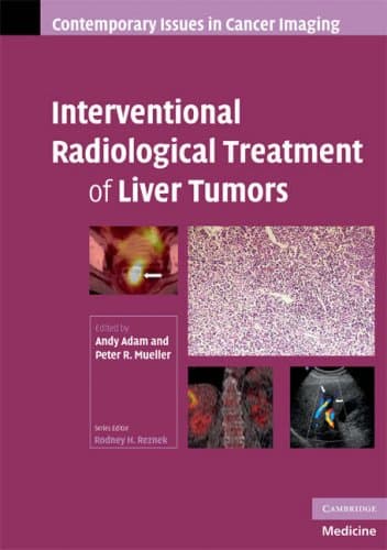 کتاب Interventional Radiological Treatment of Liver Tumors (Contemporary Issues in Cancer Imaging) نسخه کامل