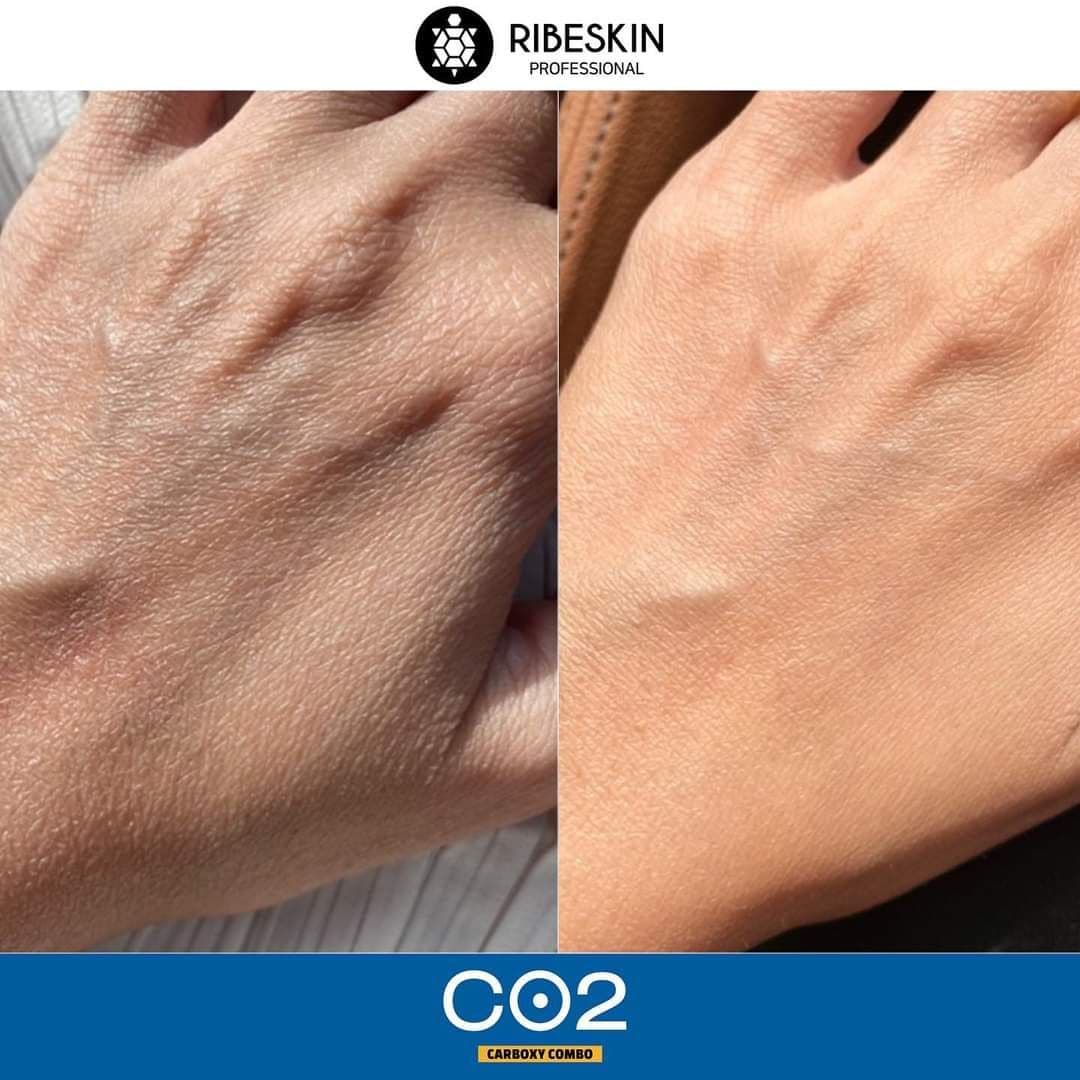 ژل کربوکسی تراپی برند ریب اسکین — تصویر ۳