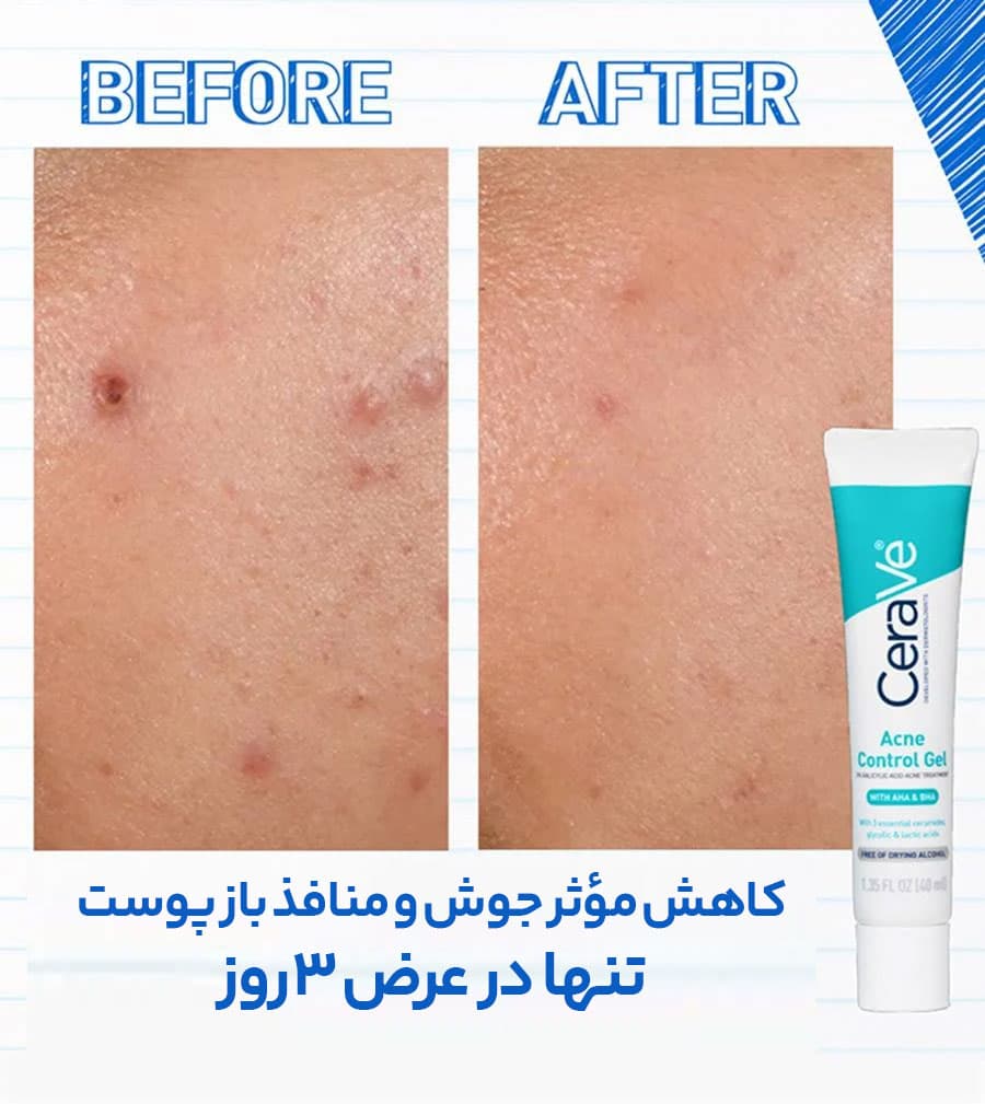 ژل ضد جوش سراوی CERAVE ACNE CONTROL GEL — تصویر ۲