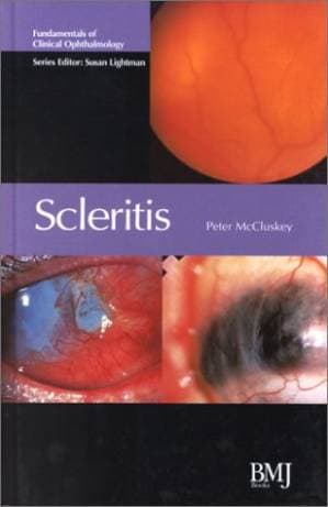 دانلود کتاب Scleritis (Fundamentals in Clinical Ophthalmology)